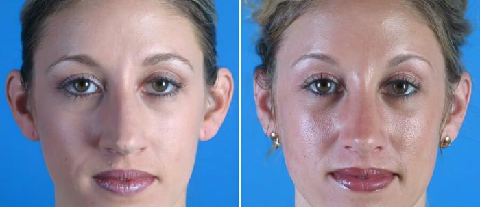 Ear Reshaping Before & After Case 18166