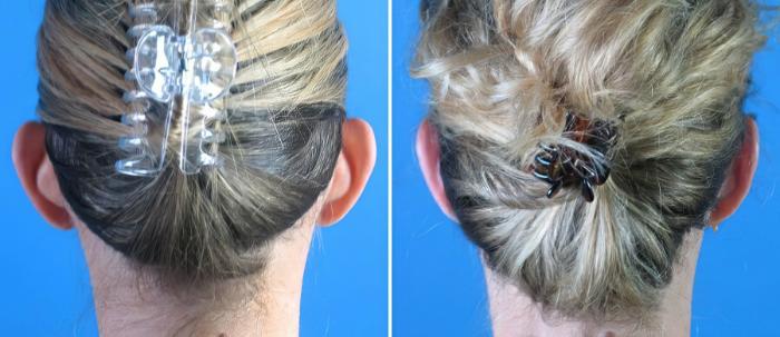 Ear Reshaping Before & After Case 18166