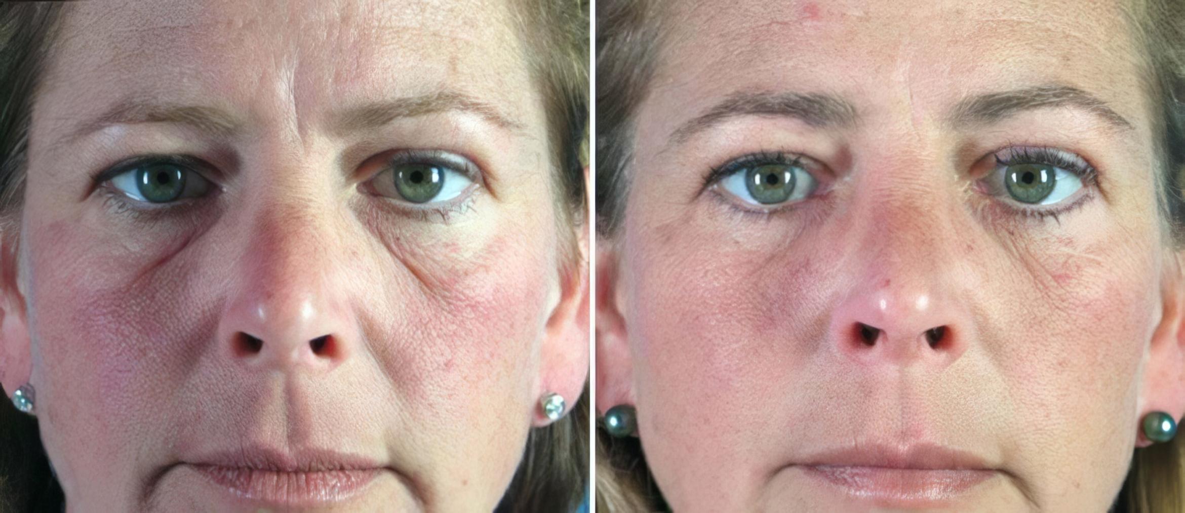 Eyelid Lift Before & After Case 16423