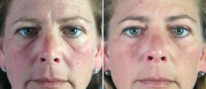 Eyelid Lift Before & After Case 16423