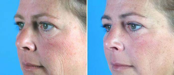 Eyelid Lift Before & After Case 16423