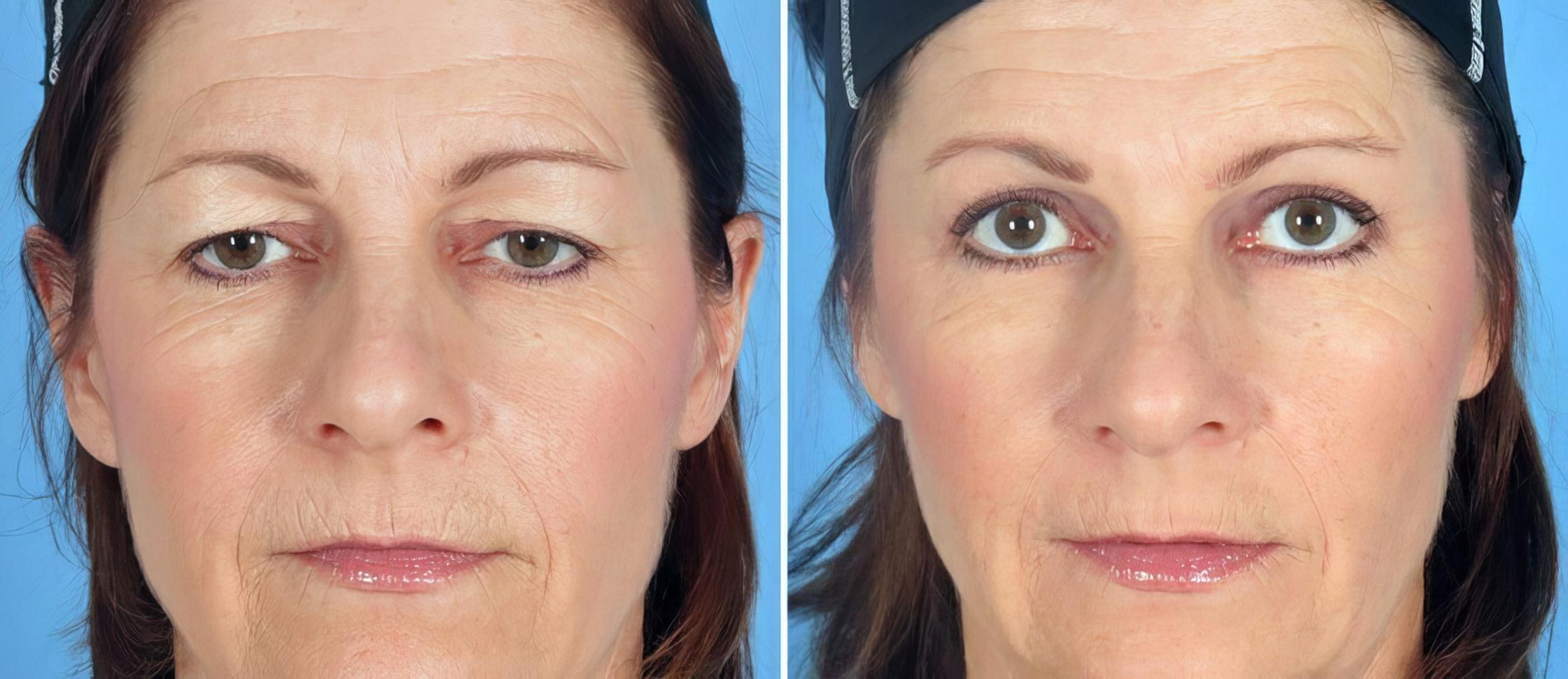 Eyelid Lift Before & After Case 17454