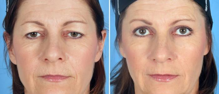 Eyelid Lift Before & After Case 17454