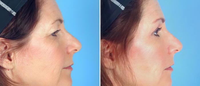 Eyelid Lift Before & After Case 17454