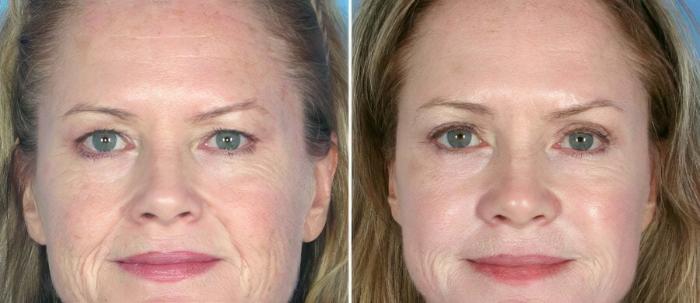 Eyelid Lift Before & After Case 17462