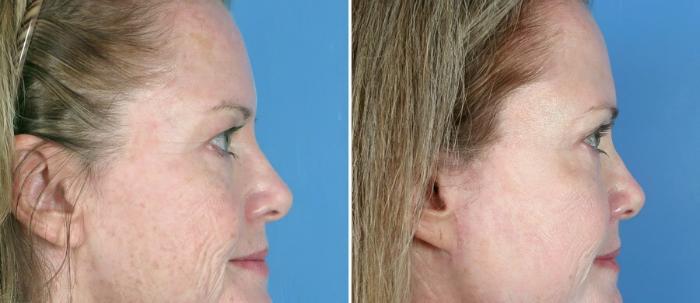 Eyelid Lift Before & After Case 17462