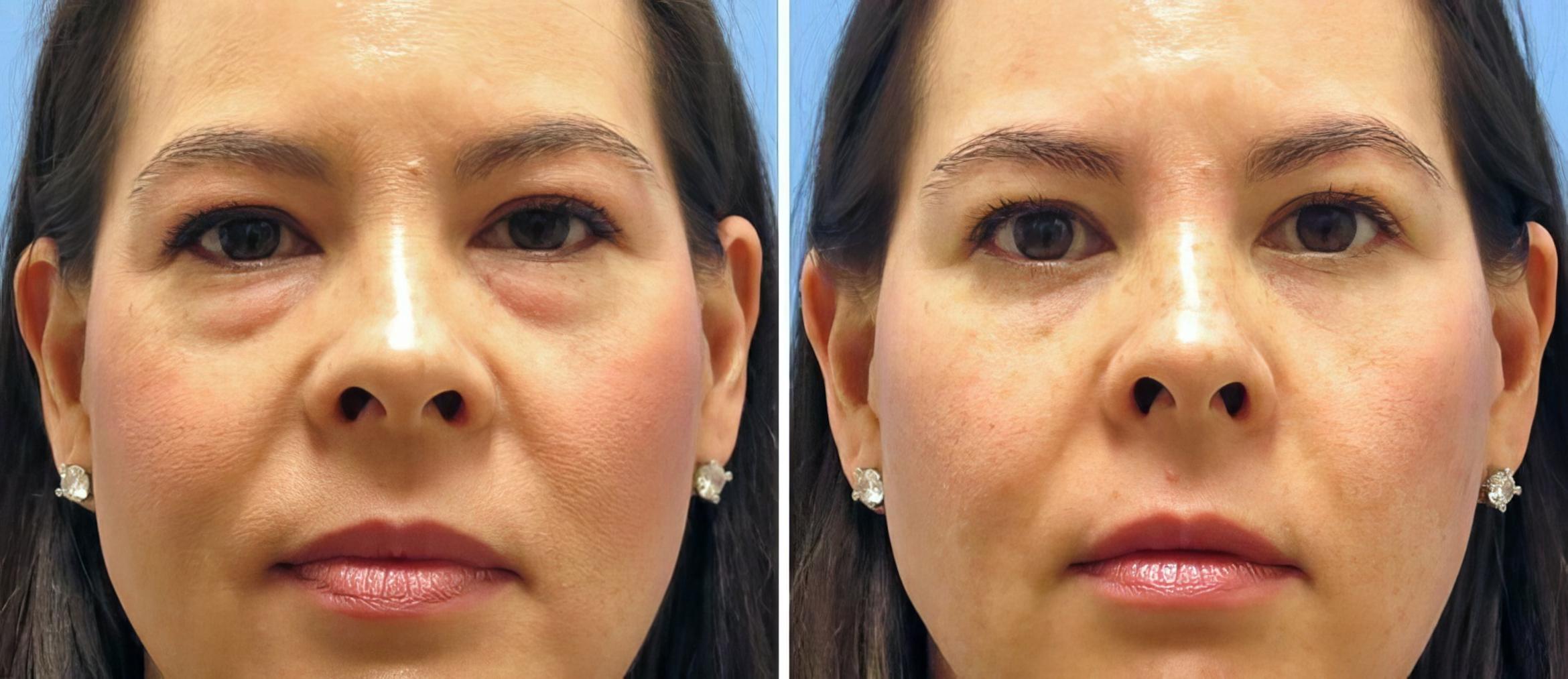 Eyelid Lift Before & After Case 17743