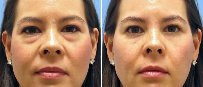 Eyelid Lift Before & After Case 17743