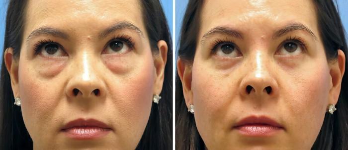 Eyelid Lift Before & After Case 17743