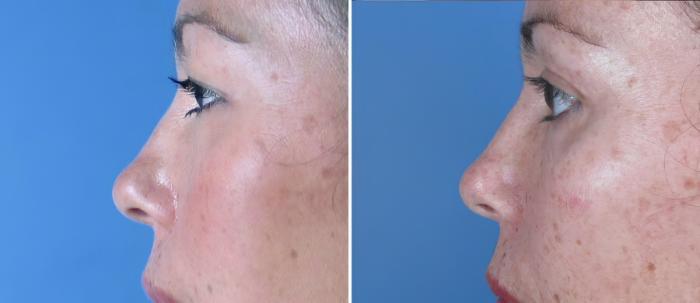 Eyelid Lift Before & After Case 18766
