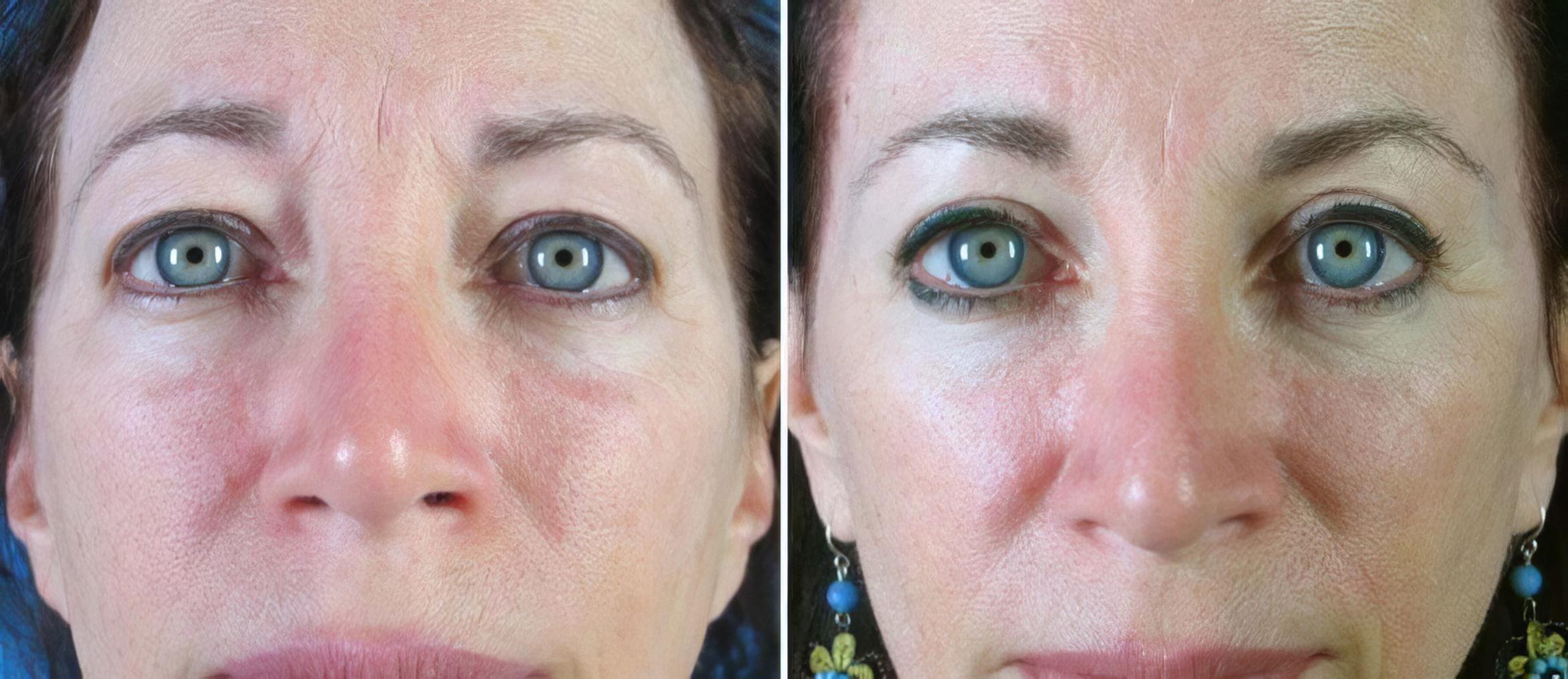 Eyelid Lift Before & After Case 18769