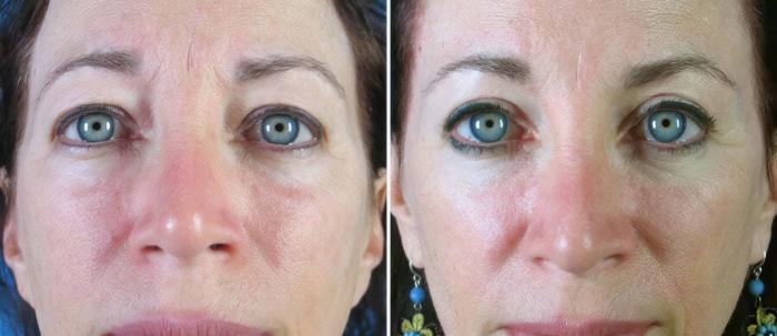 Eyelid Lift Before & After Case 18769
