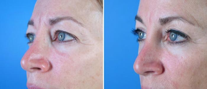 Eyelid Lift Before & After Case 18769