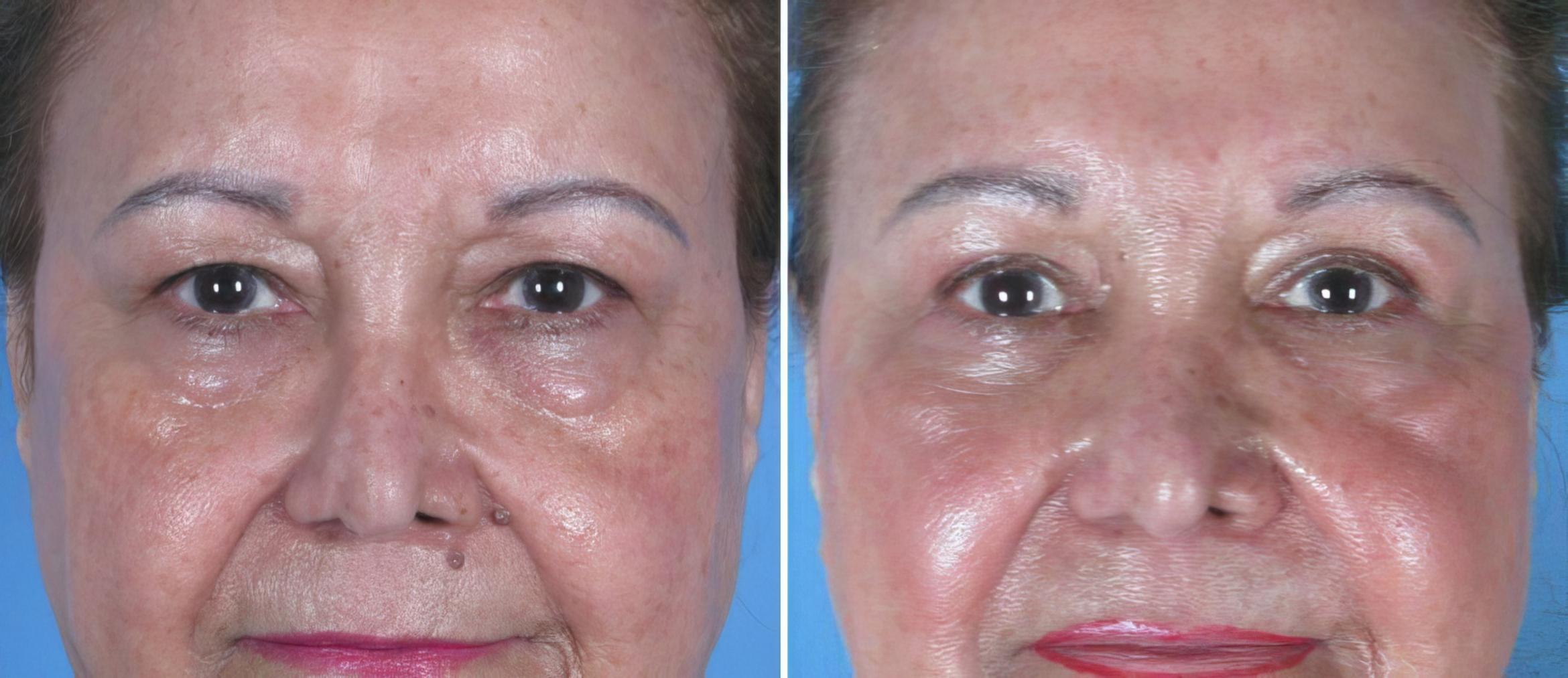Eyelid Lift Before & After Case 18772