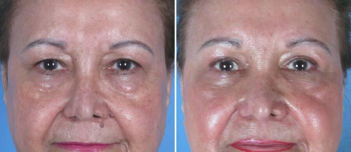 Eyelid Lift Before & After Case 18772