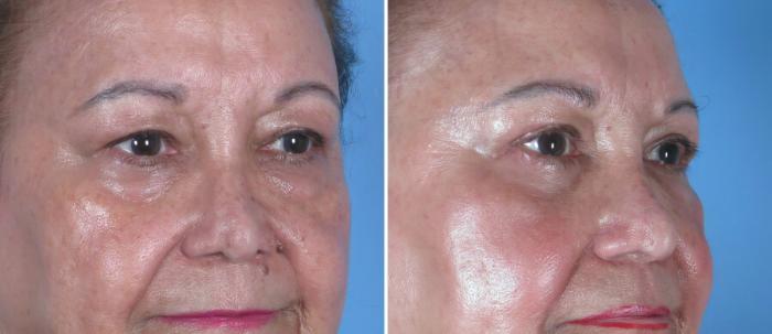 Eyelid Lift Before & After Case 18772