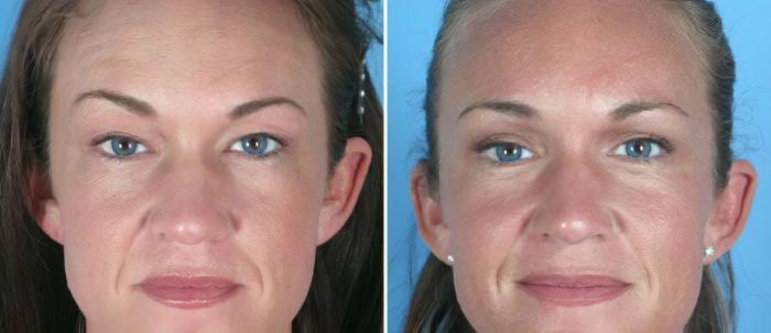 Eyelid Lift Before & After Case 18775