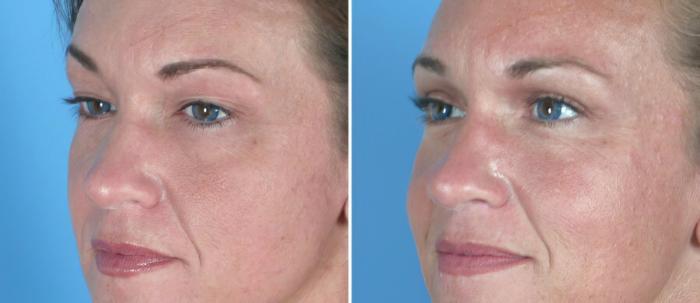 Eyelid Lift Before & After Case 18775