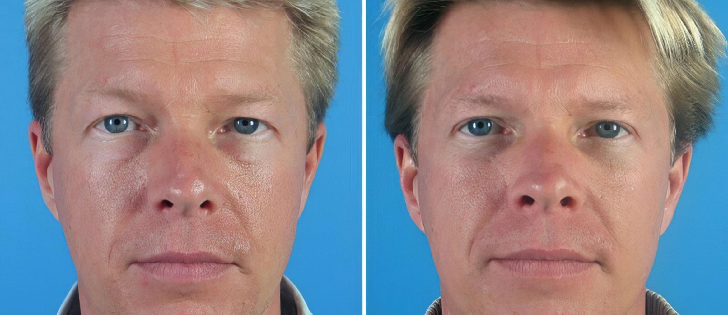 Eyelid Lift Before & After Case 18778