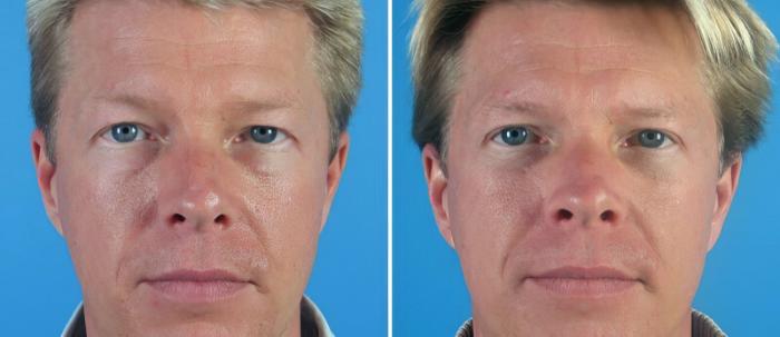 Eyelid Lift Before & After Case 18778