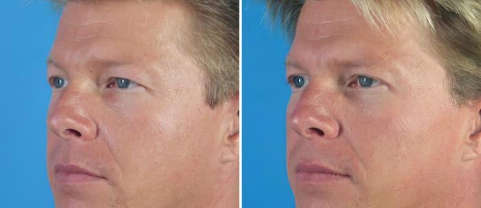 Eyelid Lift Before & After Case 18778
