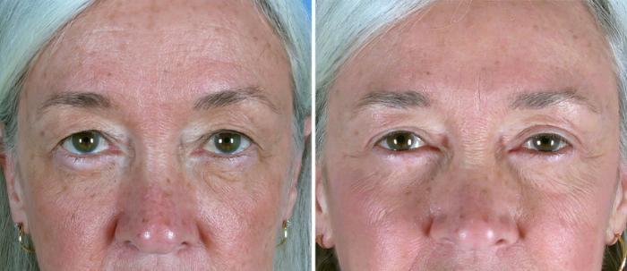 Eyelid Lift Before & After Case 19257