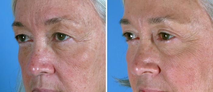 Eyelid Lift Before & After Case 19257