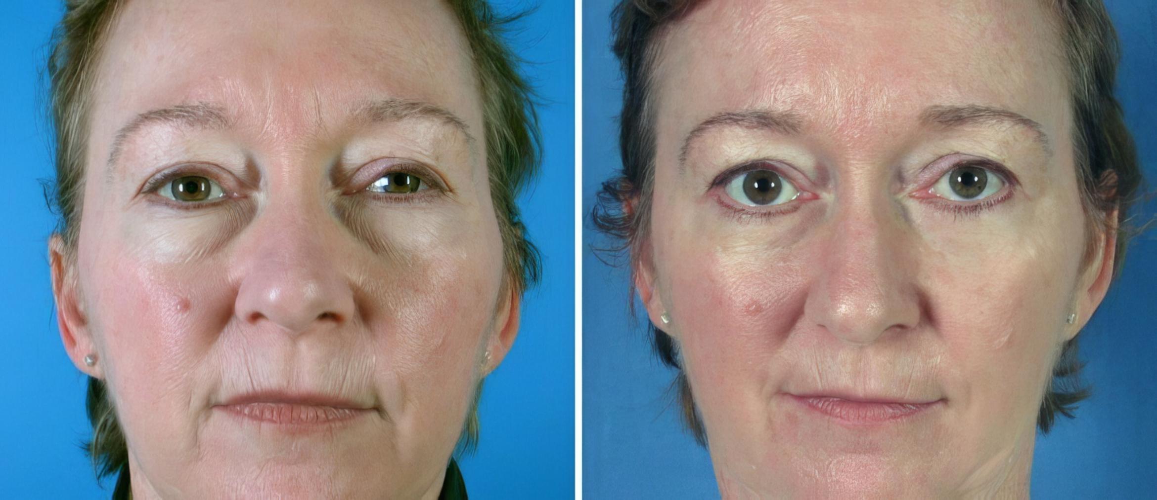 Eyelid Lift Before & After Case 19260