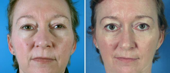 Eyelid Lift Before & After Case 19260