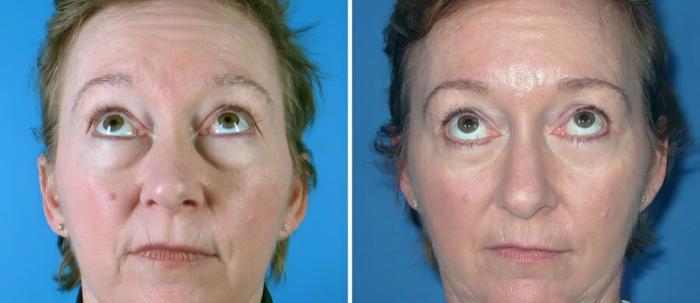 Eyelid Lift Before & After Case 19260