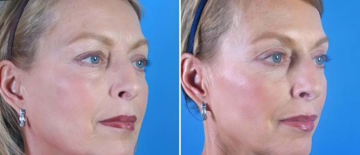 Eyelid Lift Before & After Case 19343