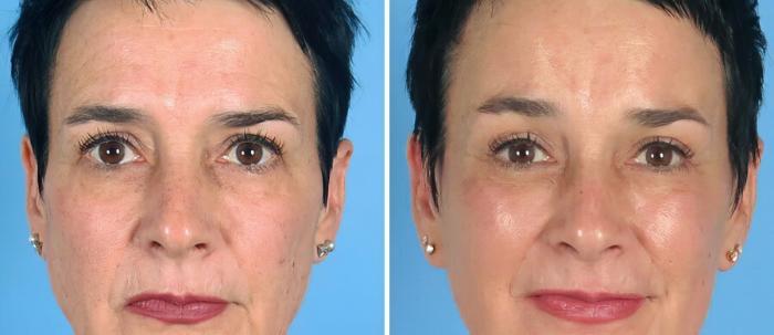 Eyelid Lift Before & After Case 19548