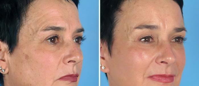 Eyelid Lift Before & After Case 19548