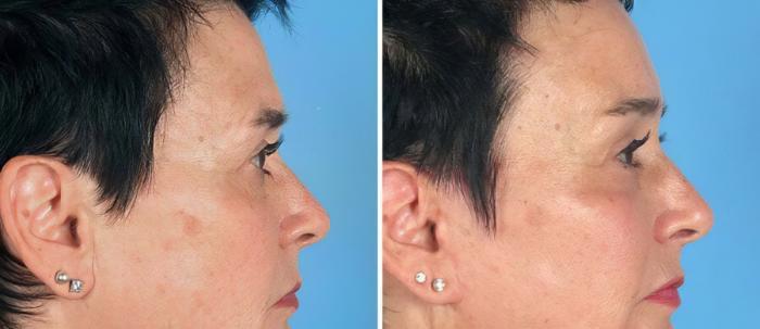Eyelid Lift Before & After Case 19548