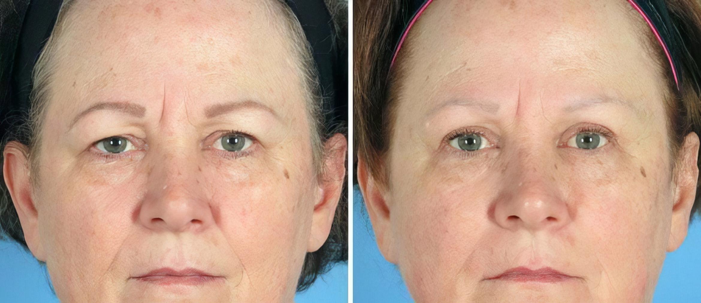Eyelid Lift Before & After Case 19552