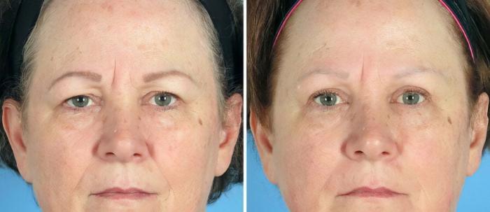 Eyelid Lift Before & After Case 19552
