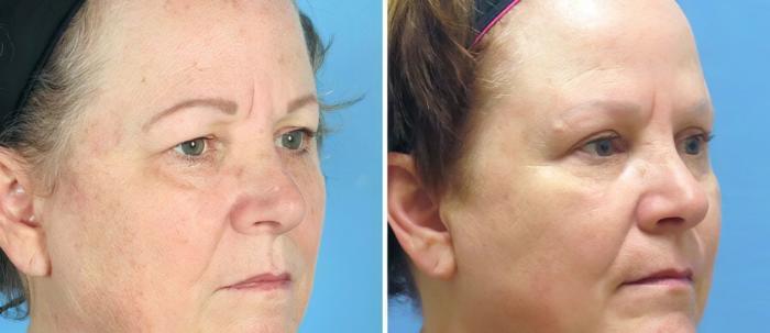 Eyelid Lift Before & After Case 19552