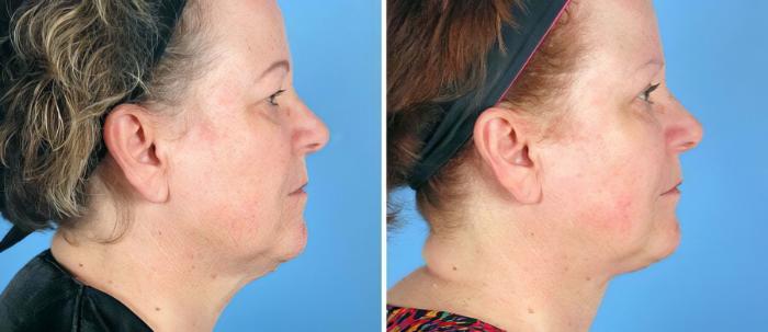 Eyelid Lift Before & After Case 19552