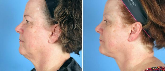 Eyelid Lift Before & After Case 19552