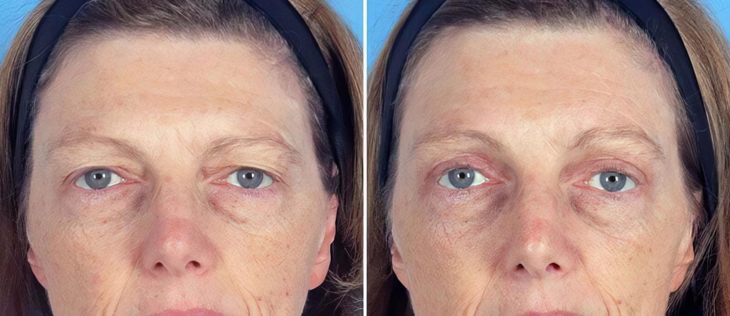 Eyelid Lift Before & After Case 19560