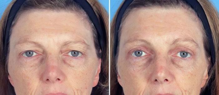 Eyelid Lift Before & After Case 19560