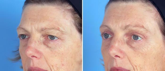Eyelid Lift Before & After Case 19560