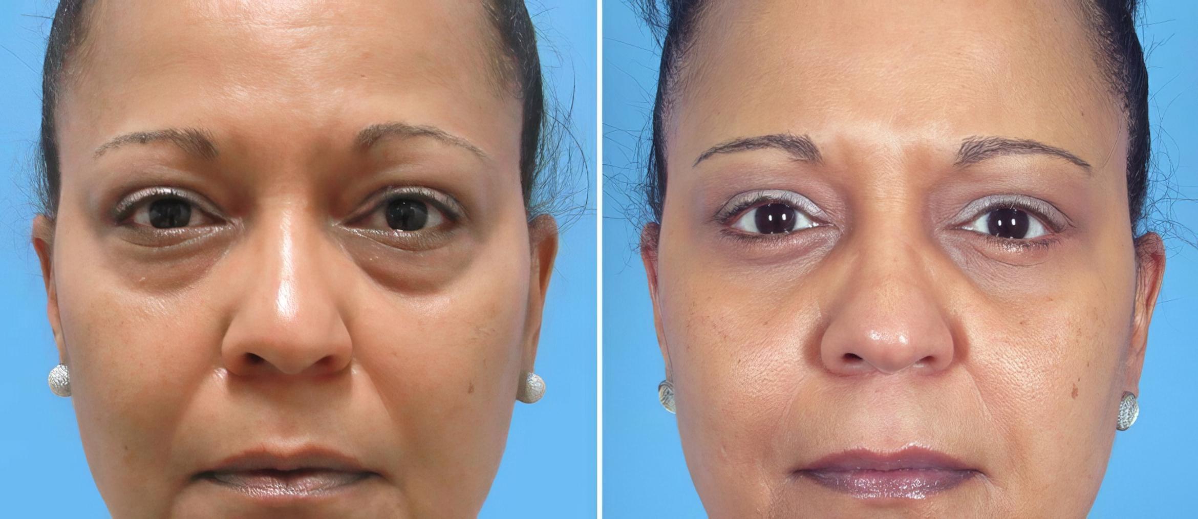 Eyelid Lift Before & After Case 26149
