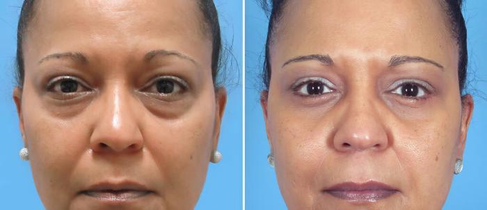 Eyelid Lift Before & After Case 26149