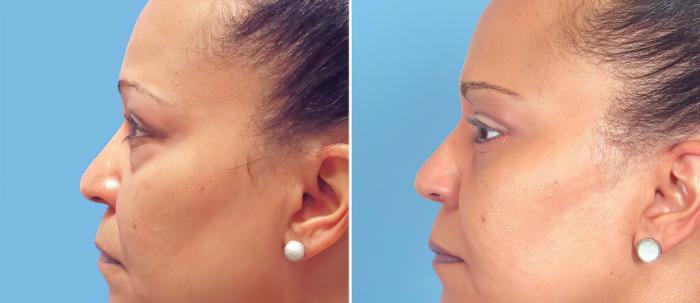 Eyelid Lift Before & After Case 26149