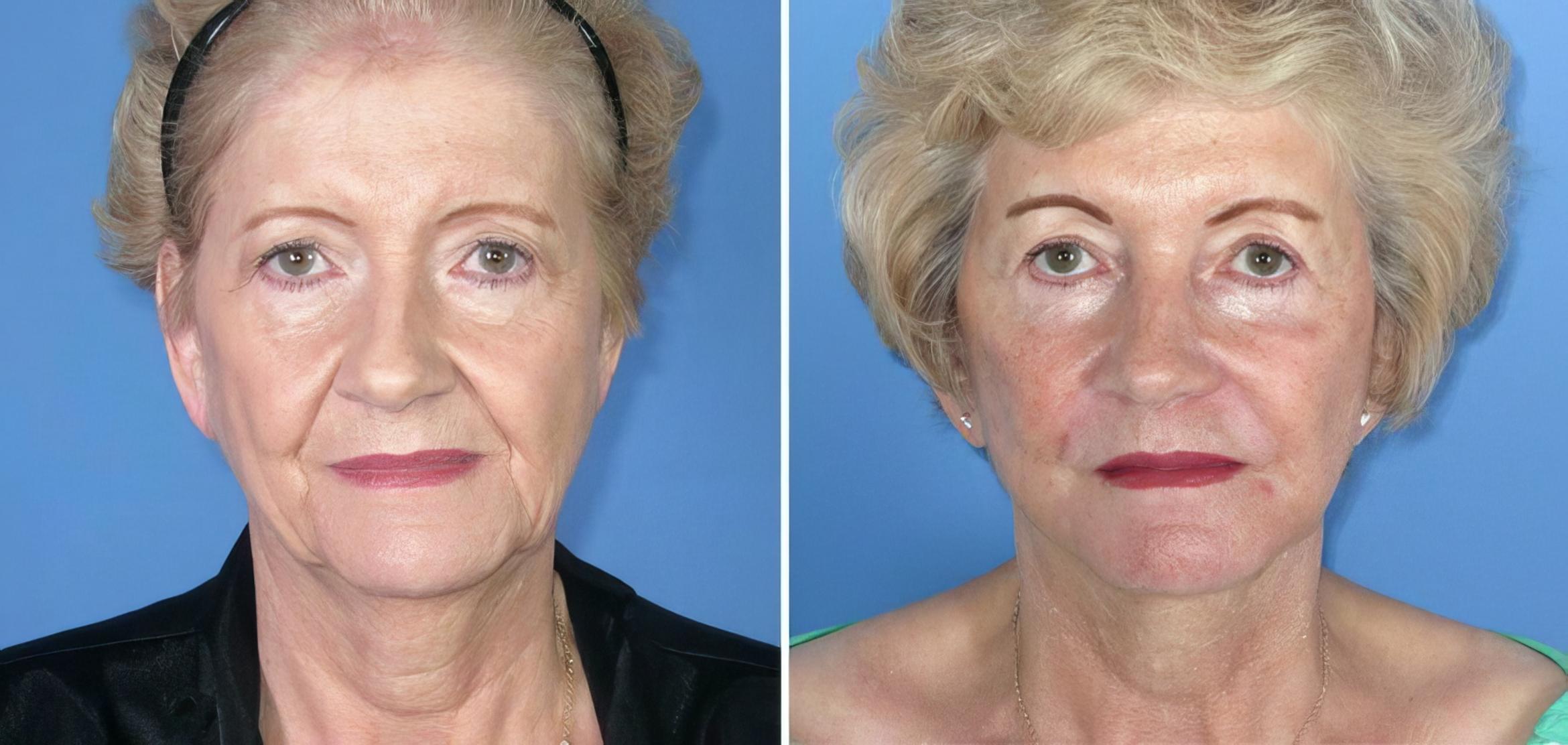Facelift Before & After Case 17708
