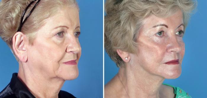 Facelift Before & After Case 17708