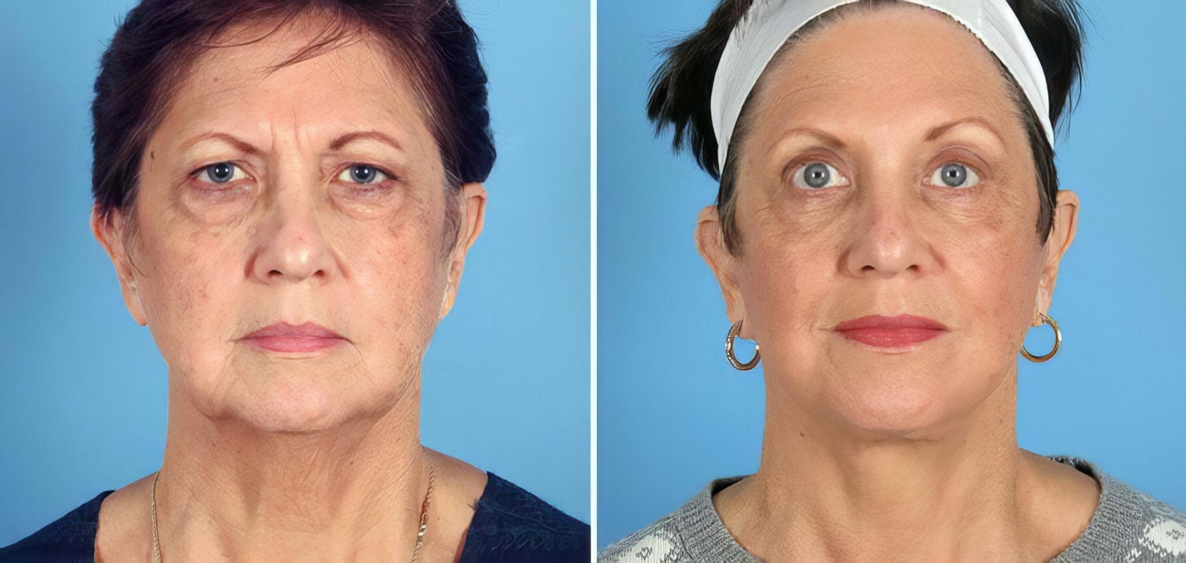 Facelift Before & After Case 17714