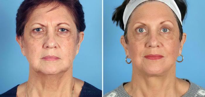 Facelift Before & After Case 17714