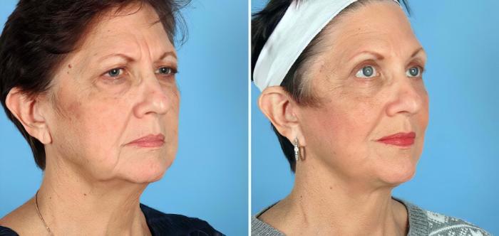 Facelift Before & After Case 17714